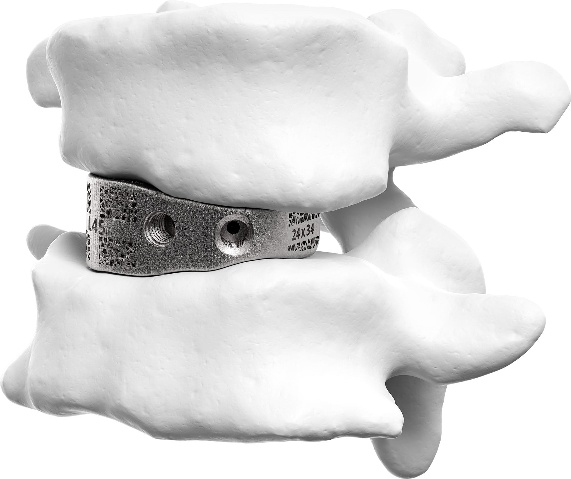 titanium block implant